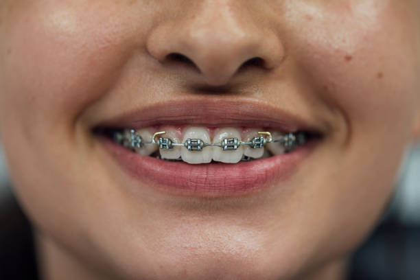 Transform Your Smile in One Visit with Composite Bonding Newcastle Transform Your Smile